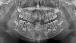 11 yaşındaki çocuğun 81 dişi olduğu tespit edildi!