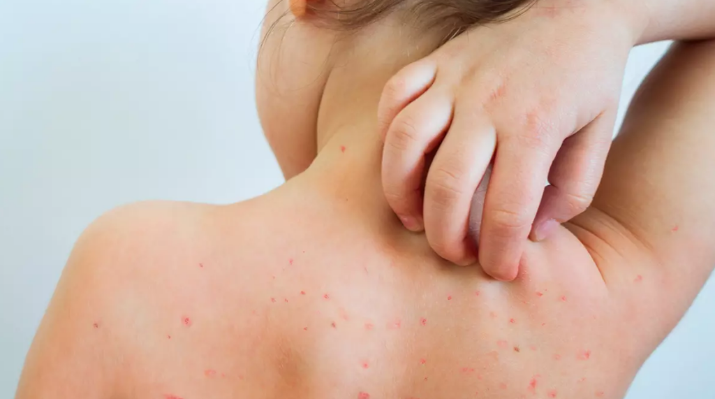 Okullarda Suçiçeği Vakaları Artıyor: Bu Belirtilere Dikkat